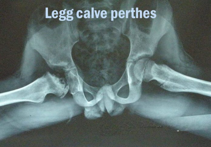 Legg calve perthes