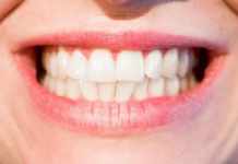 Safety tips to consider while Teeth Whitening Treatment Teeth Whitening Treatment