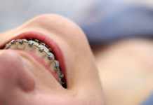 What you need to know about Impress invisible orthodontic treatment treatment