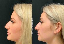 Benefits Of A Liquid Rhinoplasty Vs Surgical Rhinoplasty?