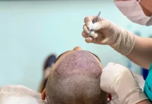 Details about FUE Hair Transplant Process
