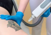 Tattoo Removal Safety: What to Consider Before Starting the Process
