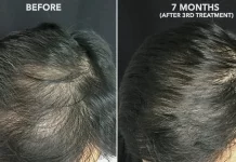Platelet-Rich Plasma (PRP) Therapy for Hair Loss: Does It Work?