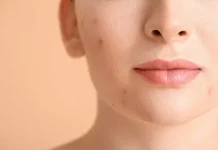 5 Life-Changing Skincare Habits for Vitiligo-Prone Skin